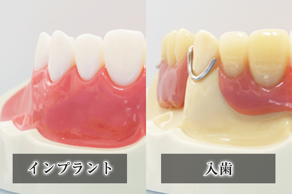 入れ歯の薄さの違いを説明するイラスト