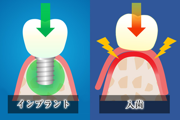 入れ歯の安定性を説明するイラスト
