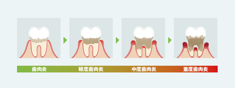 むし歯の進行を説明するイラスト