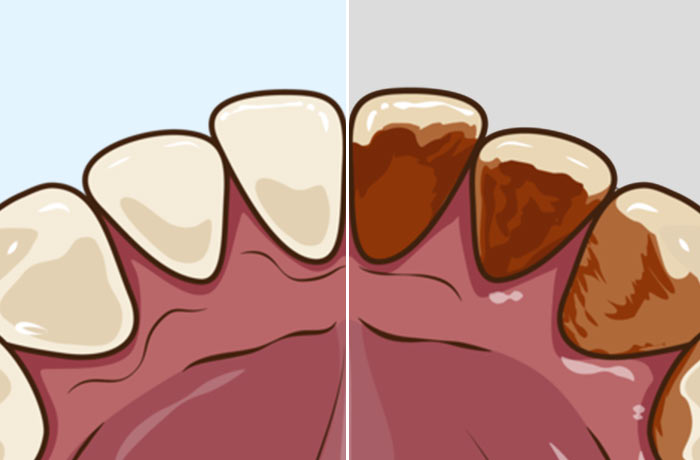 ⻭の着⾊汚れ