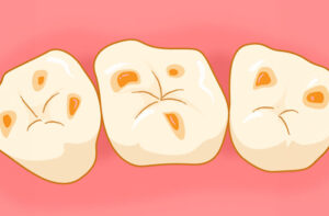 3月４日は「酸蝕歯の日」です！